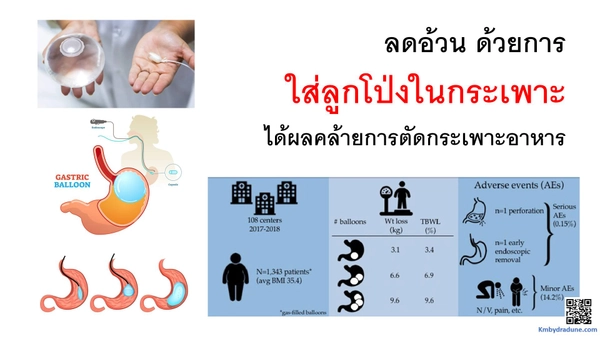 ลดน้ำหนักโดยใส่ลูกโป่ง ดีกว่าผ่าตัดกระเพาะ แต่เหมาะกับผู้มีภาวะอ้วนรุนแรง