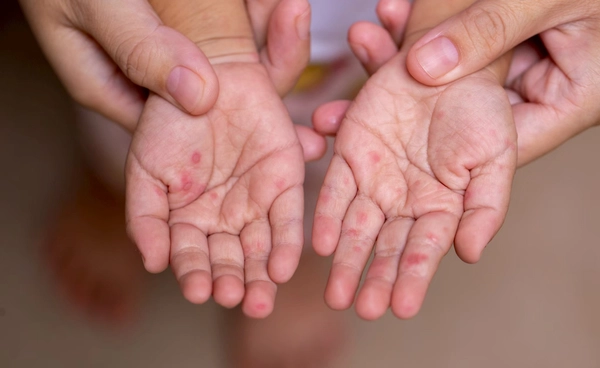 มือเท้าปาก พุ่งรับหน้าฝน! ปี 69 ป่วยสะสมแล้ว 16,332 ราย 