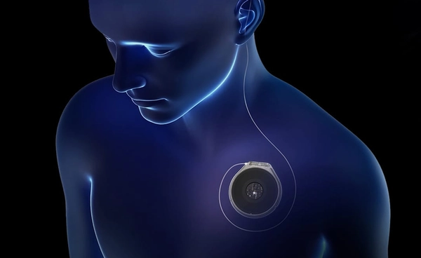 Paradromics ฝังชิปสมองมนุษย์สำเร็จรายแรก ท้าชน Neuralink อีลอน มัสก์