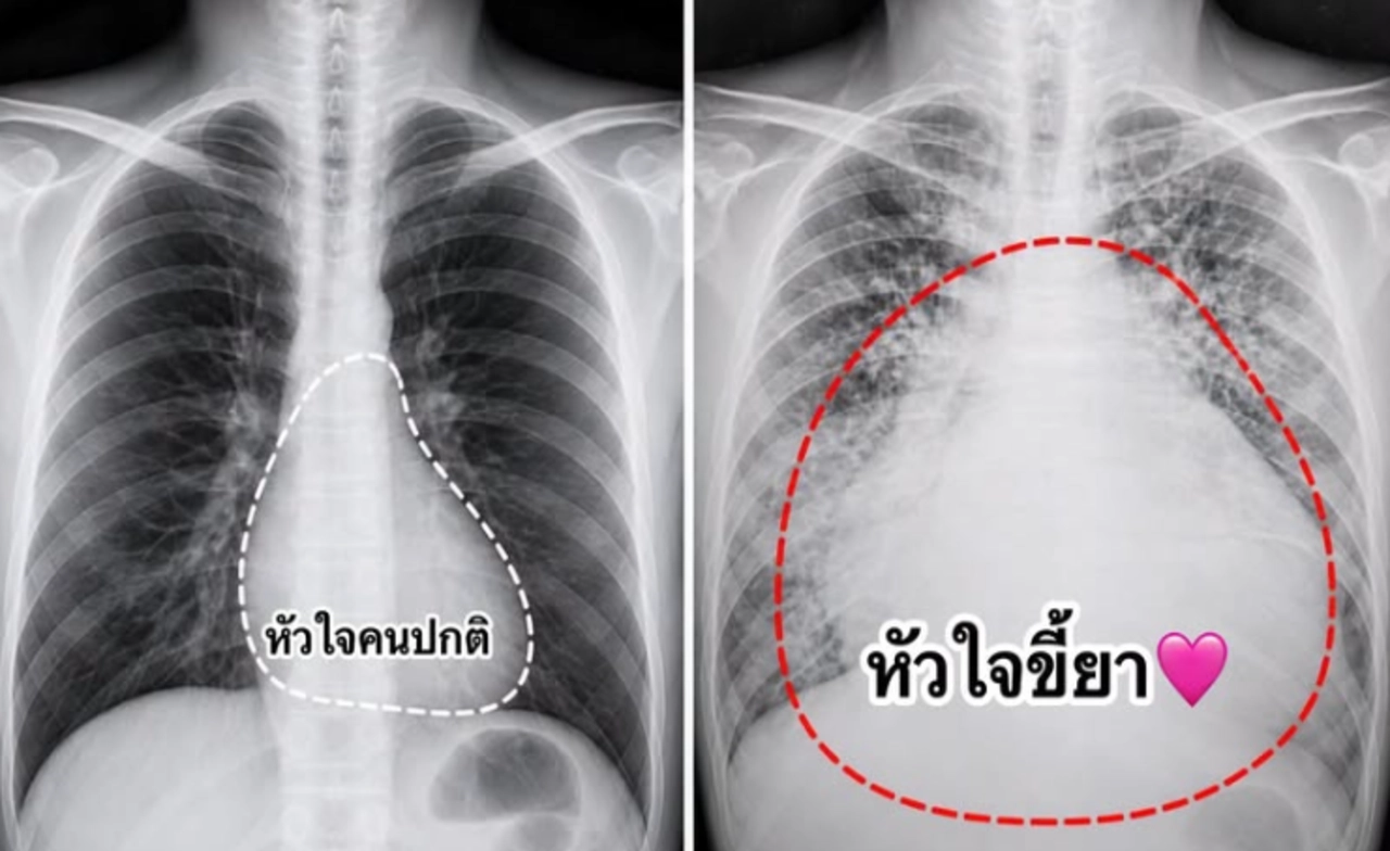 หมอเผยเคสสะเทือนใจ "หนุ่มลองยาบ้าเล่นๆ" ส่งผลให้ "หัวใจโตเท่า 2 กำปั้น" ชีวิตพัง!ก่อนอายุ 30