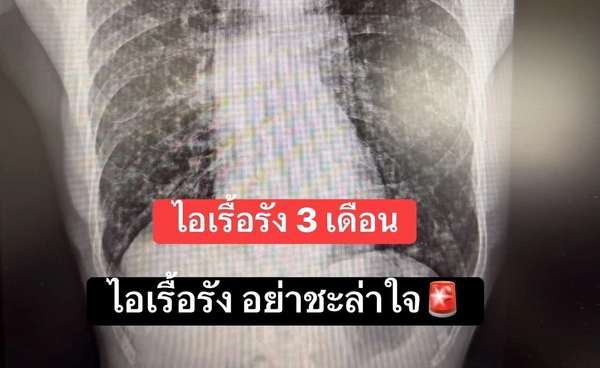 หมอเตือน! สิงอมควัน พบเคสสูบบุหรี่ 5 มวนต่อวัน ไอเรื้อรัง 3 เดือน ซื้อยามากินเอง สุดท้ายตรวจเจอมะเร็งปอด