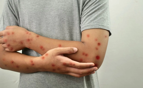 Mpox มีแนวโน้มเพิ่มขึ้นตั้งแต่เดือนมิถุนายน ป่วยสะสม 254 ราย