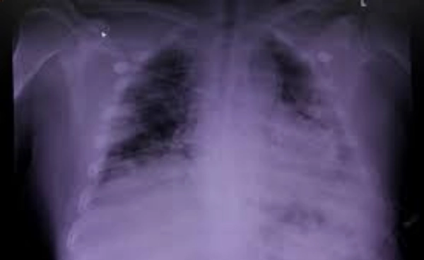 โลกเดือดจนปอดพัง!  วิกฤตอากาศพิษ กำลังคุกคามมนุษย์ทั่วโลก
