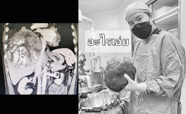 แพทย์ผ่าตัดเผยภาพก้อนมะเร็งตับขนาด 1 ฟุต ใครคือกลุ่มเสี่ยง