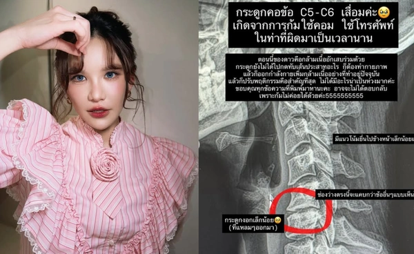 เตือนภัย! "ดาว ณัฐภัสสร" ช็อก! ตื่นมาคอขยับไม่ได้ พบ "กระดูกคอเสื่อม" จากพฤติกรรมติดมือถือ