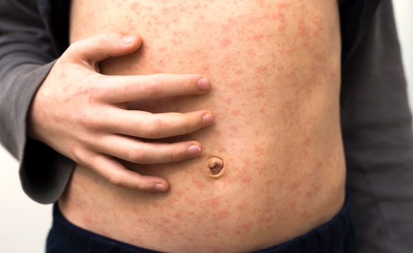 เจาะลึกเรื่องผื่น "HIV" ทำไมผื่นที่ "รักษาไม่หาย" ถึงหมายถึงการติดเชื้อมานานแล้ว ไม่ใช่เพิ่งติด!