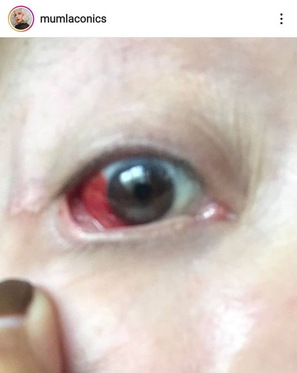 มัม ลาโคนิค โพสต์ถามชาวเน็ต หลังมีอาการตาแดงคล้ายเลือดออก