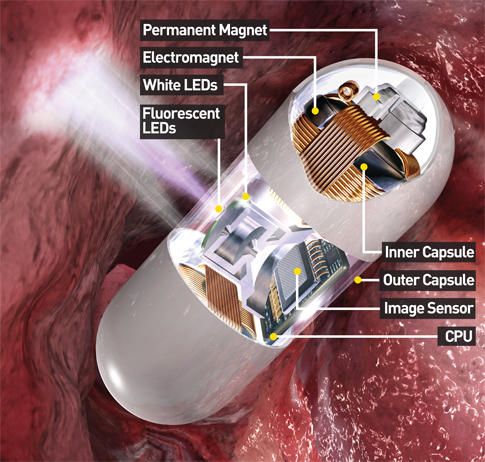 ‘PillCam’ ตรวจมะเร็งลำไส้แบบใหม่ด้วยกล้องส่องแบบกลืน
