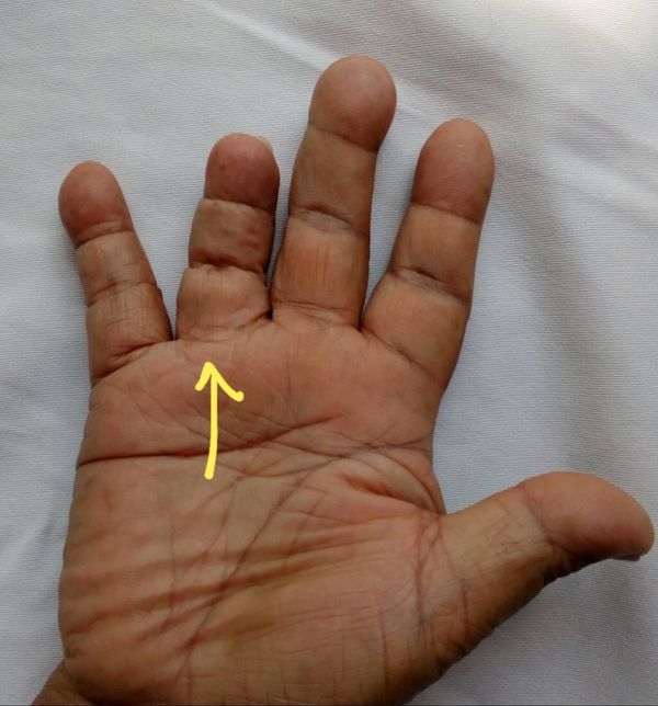 เตือนพบ วัณโรคกระดูกนิ้วมือ เคสแรกในรอบ 15 ปี