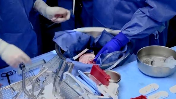 ครั้งแรกของโลก! แพทย์มะกันผ่าตัดปลูกถ่าย หัวใจหมู ในมนุษย์สำเร็จ