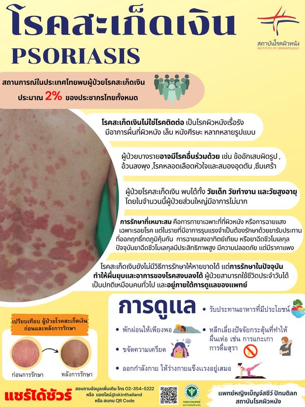 “โรคสะเก็ดเงิน” ต้องระวัง! 2% ประชากรไทยป่วยเป็นโรคนี้ 