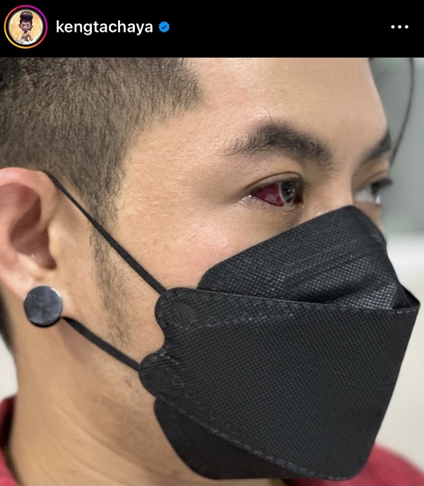 เกาขณะหลับ “เก่ง ธชย”  เส้นเลือดฝอยตาขาวแตก