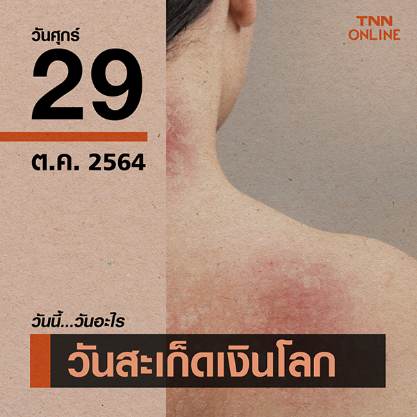 วันนี้วันอะไร วันสะเก็ดเงินโลก ตรงกับวันที่ 29 ตุลาคม วันนี้วันอะไร วันสะเก็ดเงินโลก ตรงกับวันที่ 29 ตุลาคม