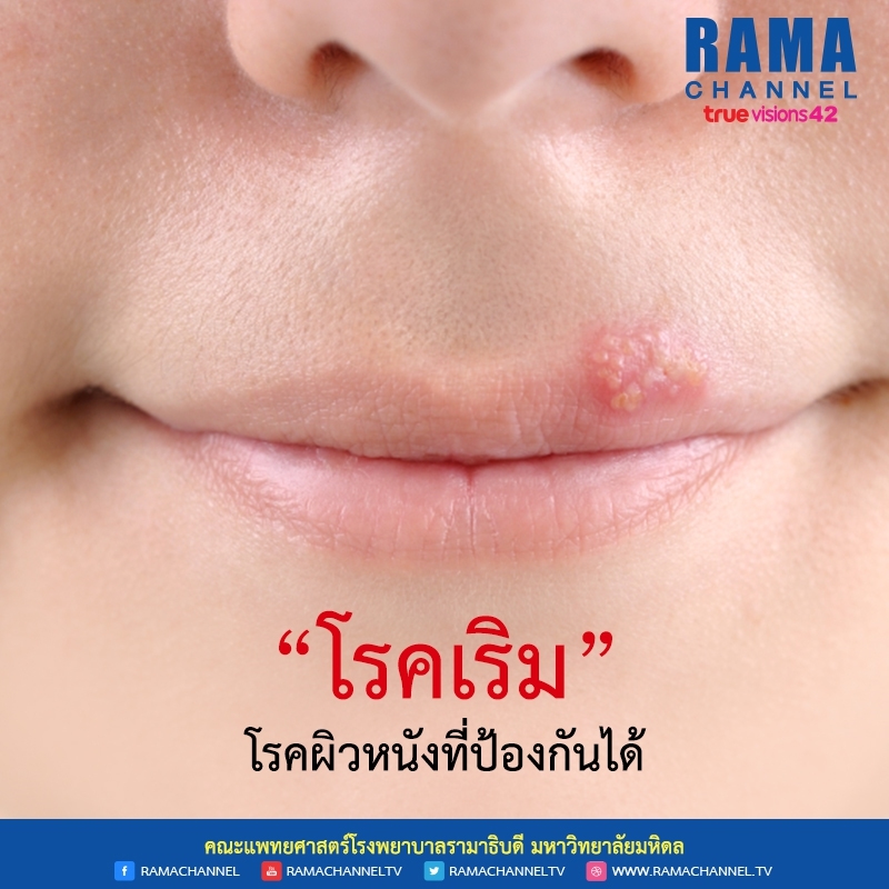 ความแตกต่างของ โรคฝีดาษลิง กับ โรคเริม