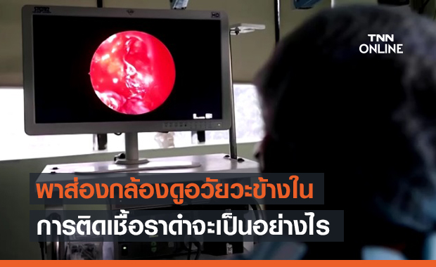 เปิดภาพ! แพทย์อินเดียส่องกล้องดู "เชื้อราดำ" ในร่างกายผู้ป่วย