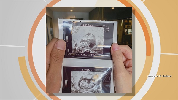 “เป้ วงมายด์”  แฮปปี้ ได้ลูกแฝด จากนี้ลุ้นเพศลูก (มีคลิป)
