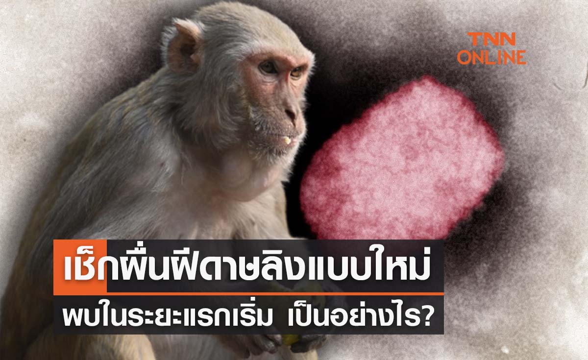 เผยข้อมูล ‘ผื่นโรคฝีดาษลิง’ แบบใหม่ พบในผู้ป่วยระยะแรกเริ่ม