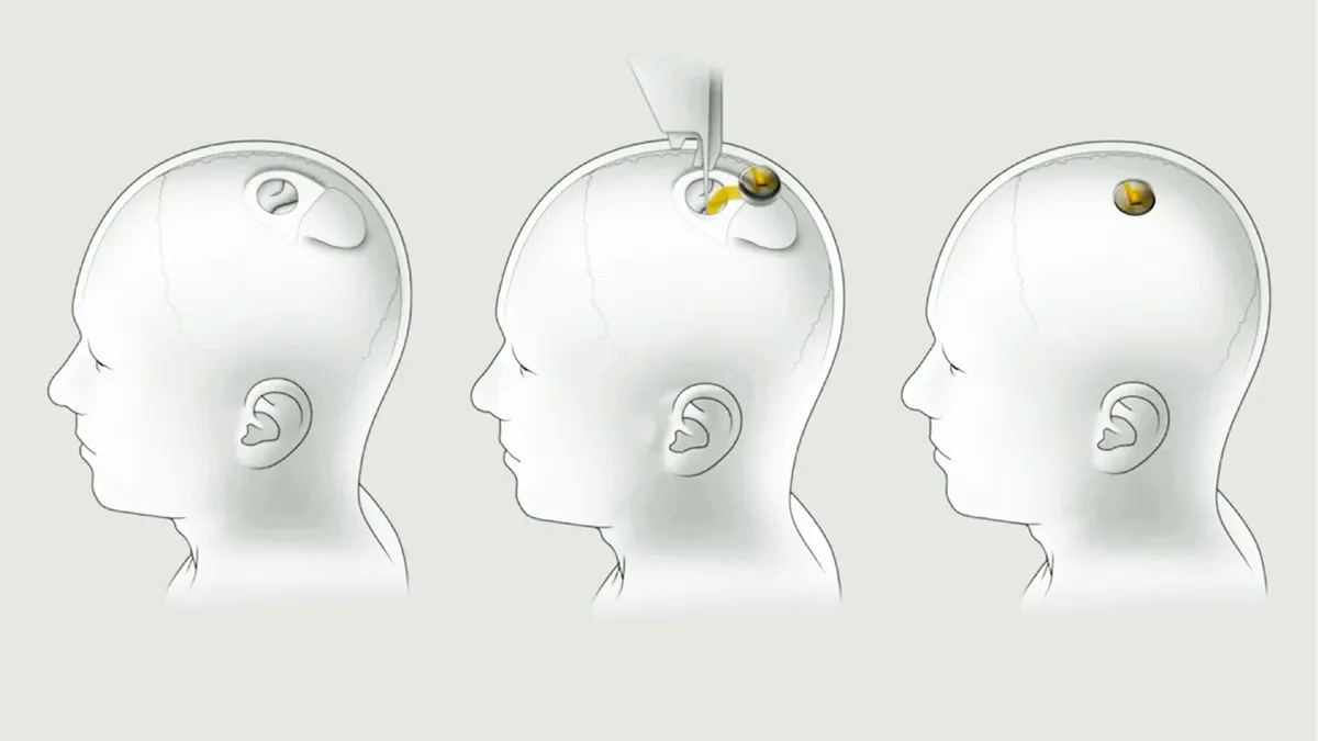 Neuralink อัปเดตความคืบหน้า โชว์คลิปผู้ป่วยฝังชิปใช้สมองควบคุมหมากรุก Neuralink อัปเดตความคืบหน้า โชว์คลิปผู้ป่วยฝังชิปใช้สมองควบคุมหมากรุก