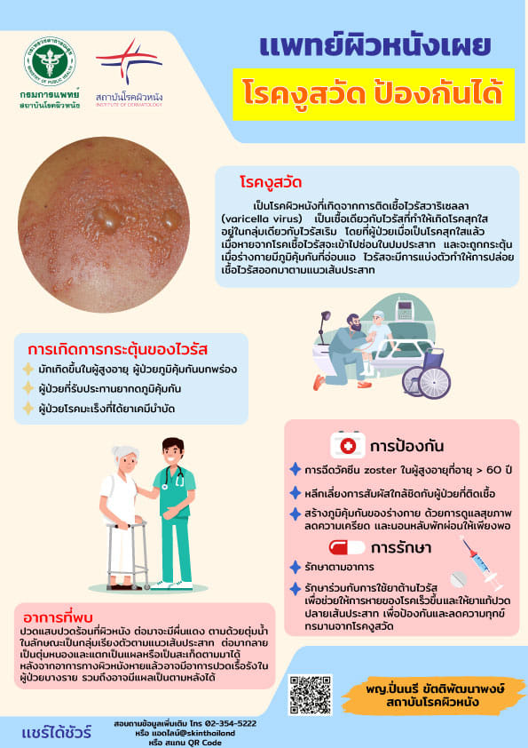 แพทย์ผิวหนัง เผย โรคงูสวัด ป้องกันได้ แพทย์ผิวหนัง เผย โรคงูสวัด ป้องกันได้