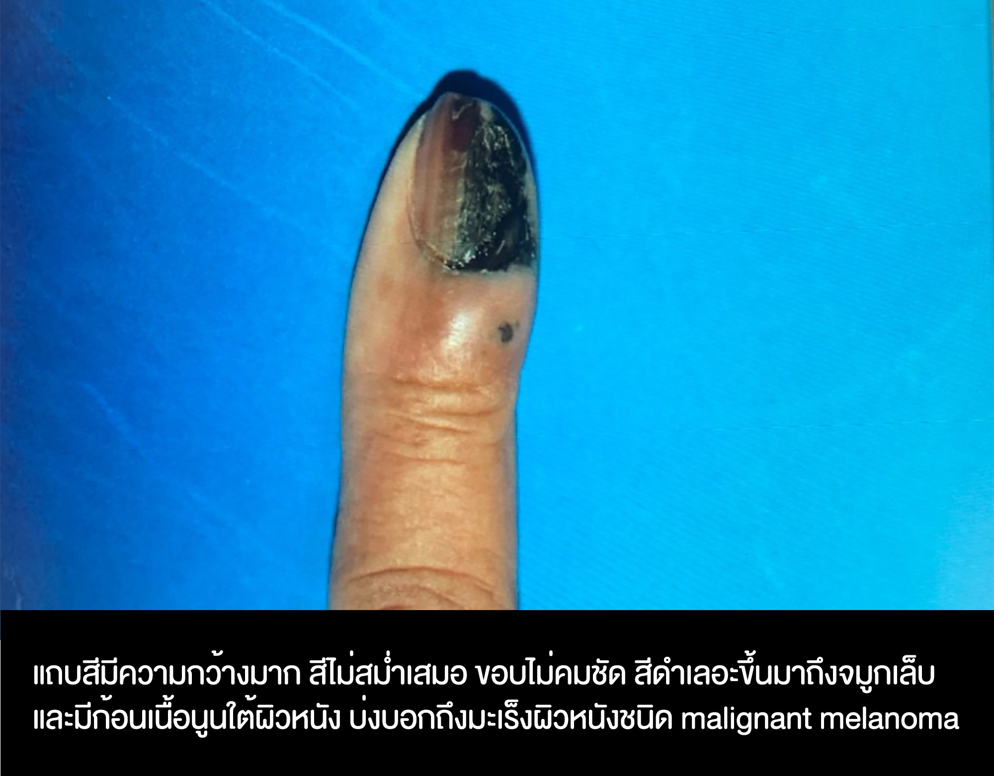 เปิดวิธีตรวจ เส้นสีน้ำตาลในเล็บ แบบไหนถึงเสี่ยงอาจเป็น “โรคมะเร็ง” เปิดวิธีตรวจ เส้นสีน้ำตาลในเล็บ แบบไหนถึงเสี่ยงอาจเป็น “โรคมะเร็ง”