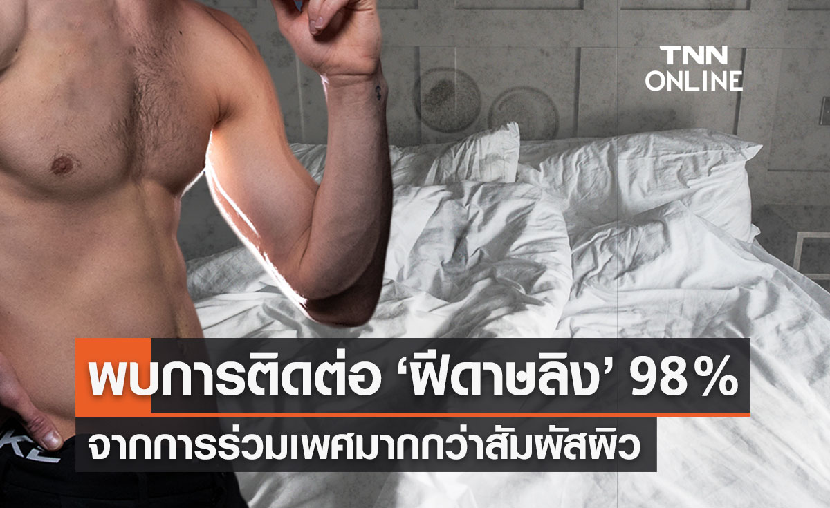 ศูนย์จีโนมฯ ชี้ "ฝีดาษลิง" ติดต่อผ่านเพศสัมพันธ์มากกว่าสัมผัสผิว