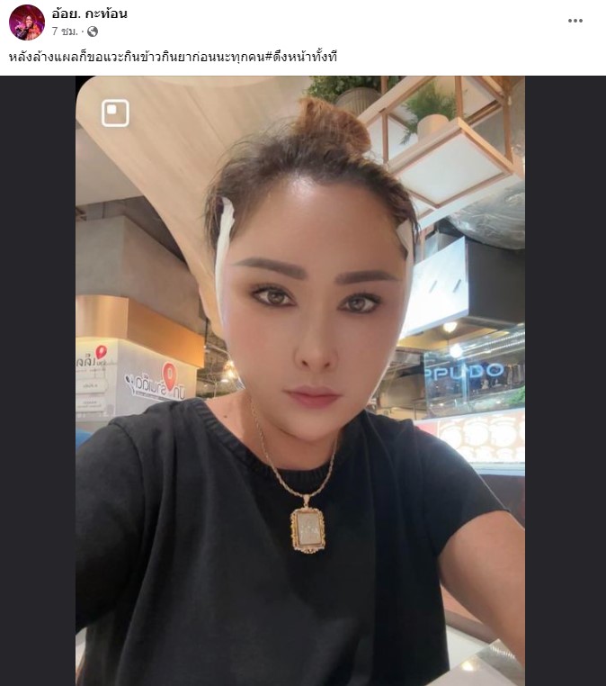 ย้อนวัยไปหลายสิบปี อ้อย กระท้อน ขึ้นเขียงศัลยกรรมดึงหน้า ย้อนวัยไปหลายสิบปี อ้อย กระท้อน ขึ้นเขียงศัลยกรรมดึงหน้า