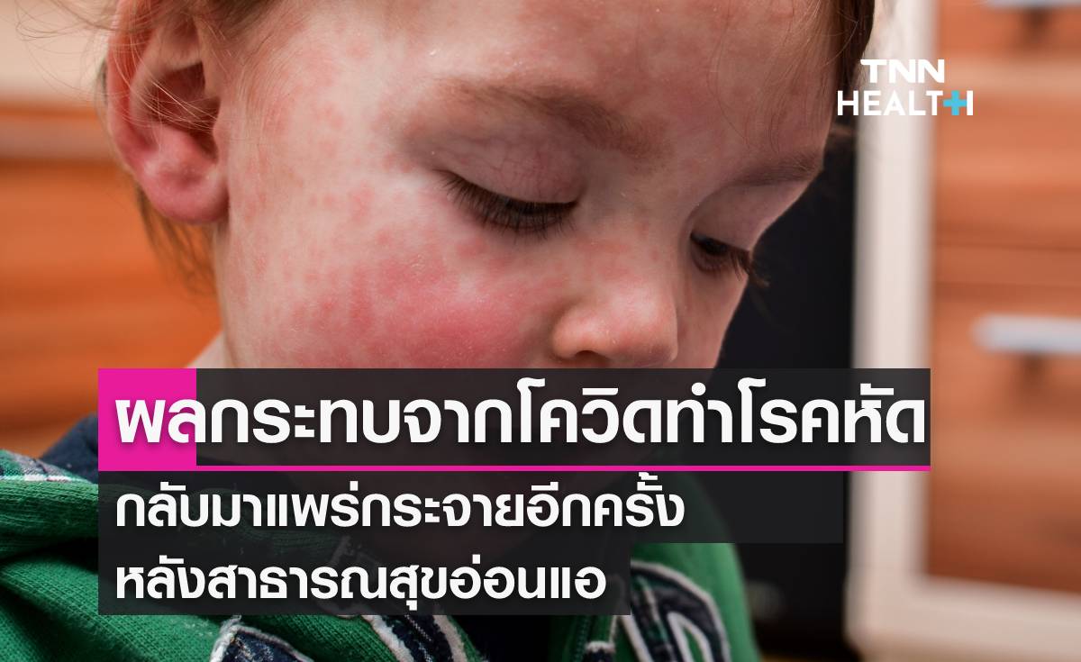 โรคหัดในเด็กแพร่กระจายมากขึ้น หลังโควิด-19 ระบาด