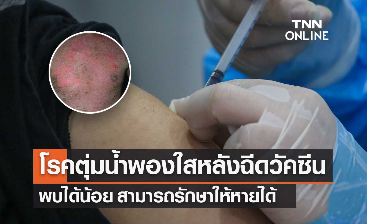 แพทย์ชี้ "โรคตุ่มน้ำพองใส" หลังฉีดวัคซีนโควิด-19 พบได้น้อย รักษาหายได้