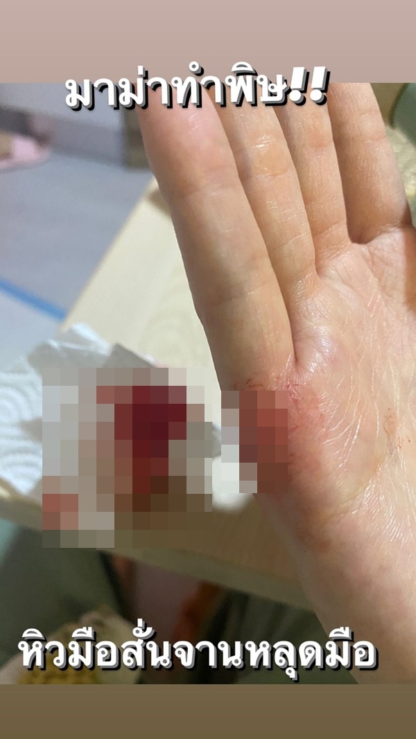 กอล์ฟ พิชญะ หิวมือสั่น จานหลุดมือ เย็บ 5 เข็ม!! กอล์ฟ พิชญะ หิวมือสั่น จานหลุดมือ เย็บ 5 เข็ม!!