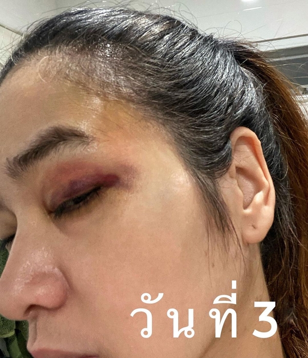 ปอย ปวีณา โพสต์ตาเขียวช้ำ เป็นอุทาหรณ์จากการเล่นสเก็ตบอร์ด ปอย ปวีณา โพสต์ตาเขียวช้ำ เป็นอุทาหรณ์จากการเล่นสเก็ตบอร์ด