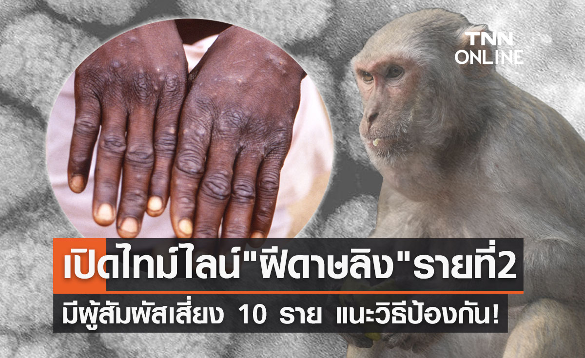 ฝีดาษลิง รายที่ 2 ของไทย เปิดไทม์ไลน์ก่อนพบเชื้อ มีผู้สัมผัสเสี่ยง 10 ราย!
