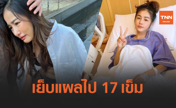 "กระแต อาร์สยาม" อัปเดตอาการล่าสุด เย็บแผลไป 17 เข็ม
