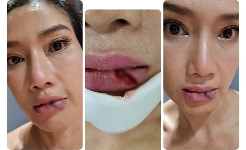 ประสบอุบัติเหตุ ดี้ ชนานา รถไถลชนเสาไฟฟ้า ปากฉีก!! ประสบอุบัติเหตุ ดี้ ชนานา รถไถลชนเสาไฟฟ้า ปากฉีก!!