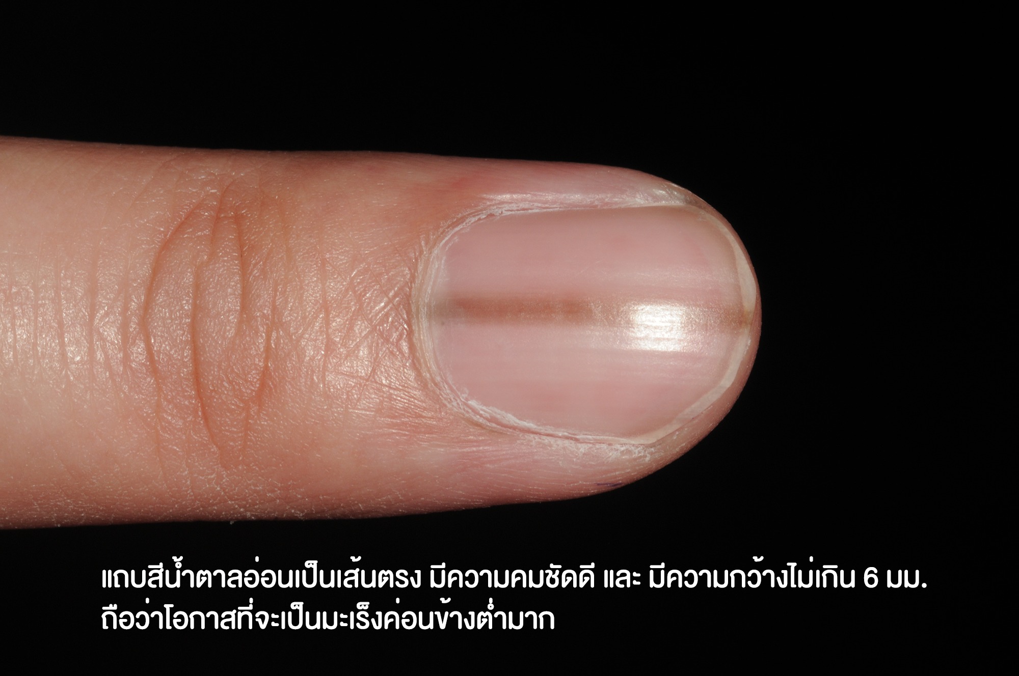 เปิดวิธีตรวจ เส้นสีน้ำตาลในเล็บ แบบไหนถึงเสี่ยงอาจเป็น “โรคมะเร็ง” เปิดวิธีตรวจ เส้นสีน้ำตาลในเล็บ แบบไหนถึงเสี่ยงอาจเป็น “โรคมะเร็ง”