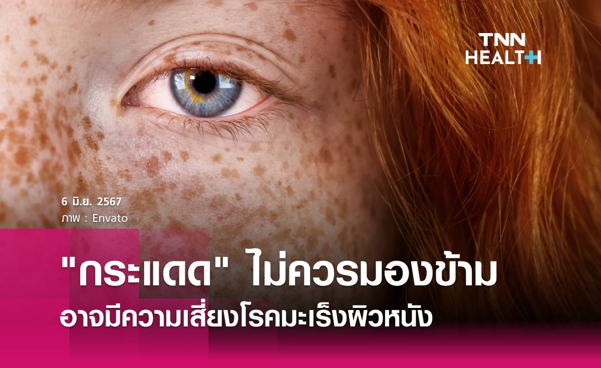 ตากแดดเป็นประจำต้องระวัง "กระแดด"
