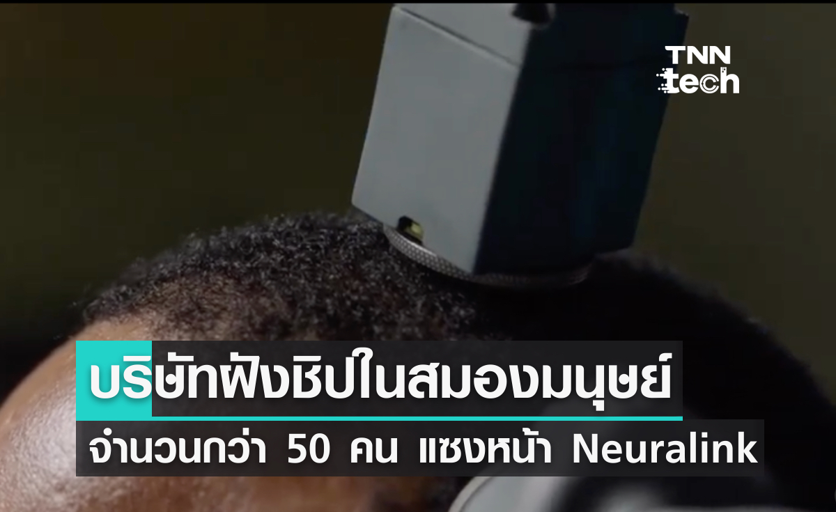 อีลอน มัสก์โดนปาดหน้า บริษัทคู่แข่งของ Neuralink ทดลองฝังชิปในสมองมนุษย์แล้ว 50 ราย