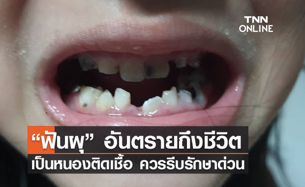 แพทย์เตือน! ฟันผุ อันตรายถึงชีวิต เป็นแล้วควรรีบรักษา