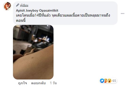 โจอี้ บอย อาการดีขึ้นเเล้ว หลังโดนแตนต่อย แพ้รุนแรง ต้องแอดมิทด่วน