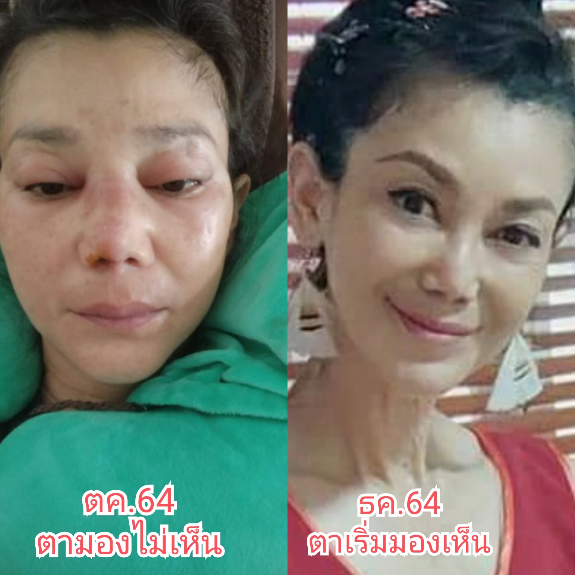 รอดตายครั้งล่าสุด!! อดีตดารา เอ๋ อัจฉรา หัวใจ-ไตวายเฉียบพลัน ทำ SLE มะเร็ง เบาหวานกำเริบ