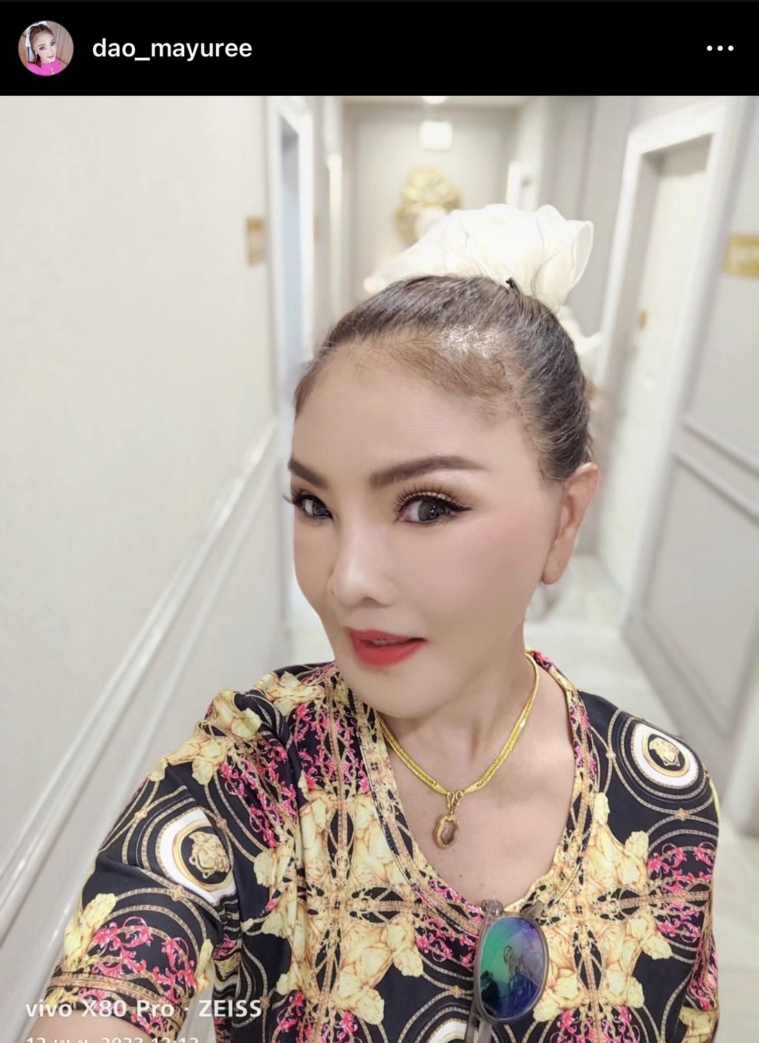 ตะลึงความสวย! ดาว มยุรี อัปเดตหน้าใหม่หลังทำศัลยกรรมครบ 14 วัน