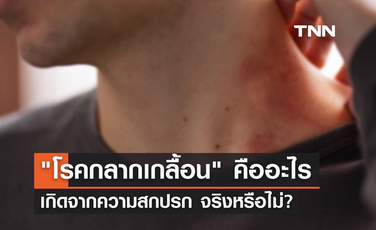"โรคกลากเกลื้อน" คืออะไร เกิดจากความสกปรก จริงหรือไม่ หาคำตอบได้ที่นี่!