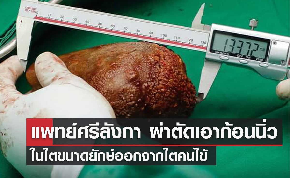 แพทย์ศรีลังกา ผ่าตัดเอาก้อนนิ่ว ในไตขนาดยักษ์ออกจากไตคนไข้