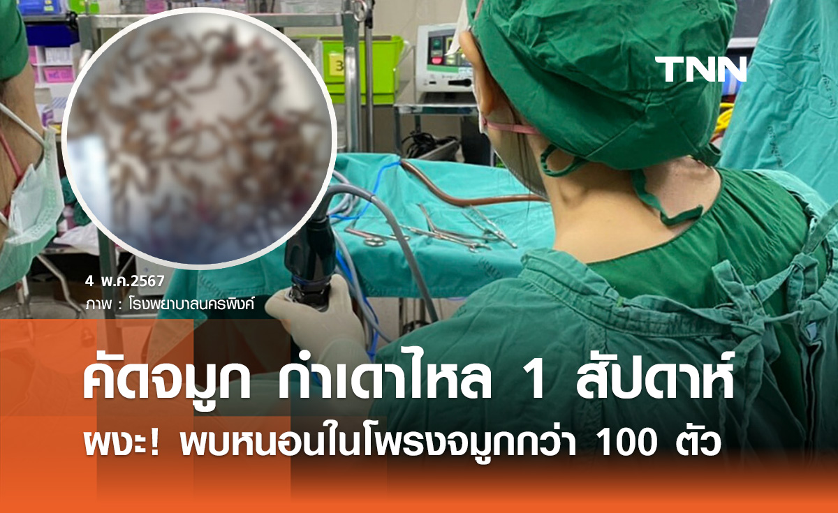 เปิดเคสคนไข้ คัดจมูก กำเดาไหล 1 สัปดาห์ ส่องกล้องพบหนอนในโพรงจมูกกว่า 100 ตัว