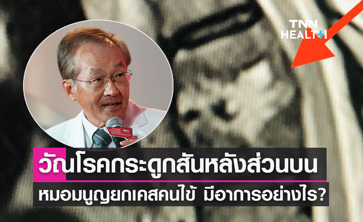 "วัณโรคกระดูกสันหลังส่วนบน" หมอมนูญยกเคสคนไข้ มีอาการอย่างไร?