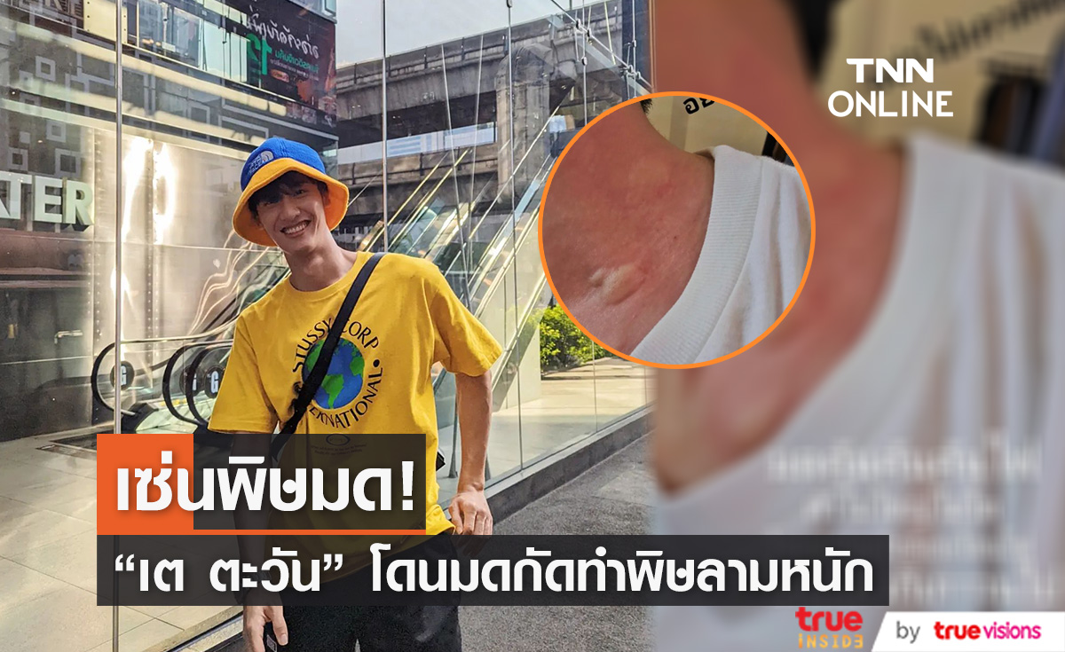 แฟนคลับเป็นห่วง!"เต ตะวัน" ถูกมดกัด พิษลามหนัก