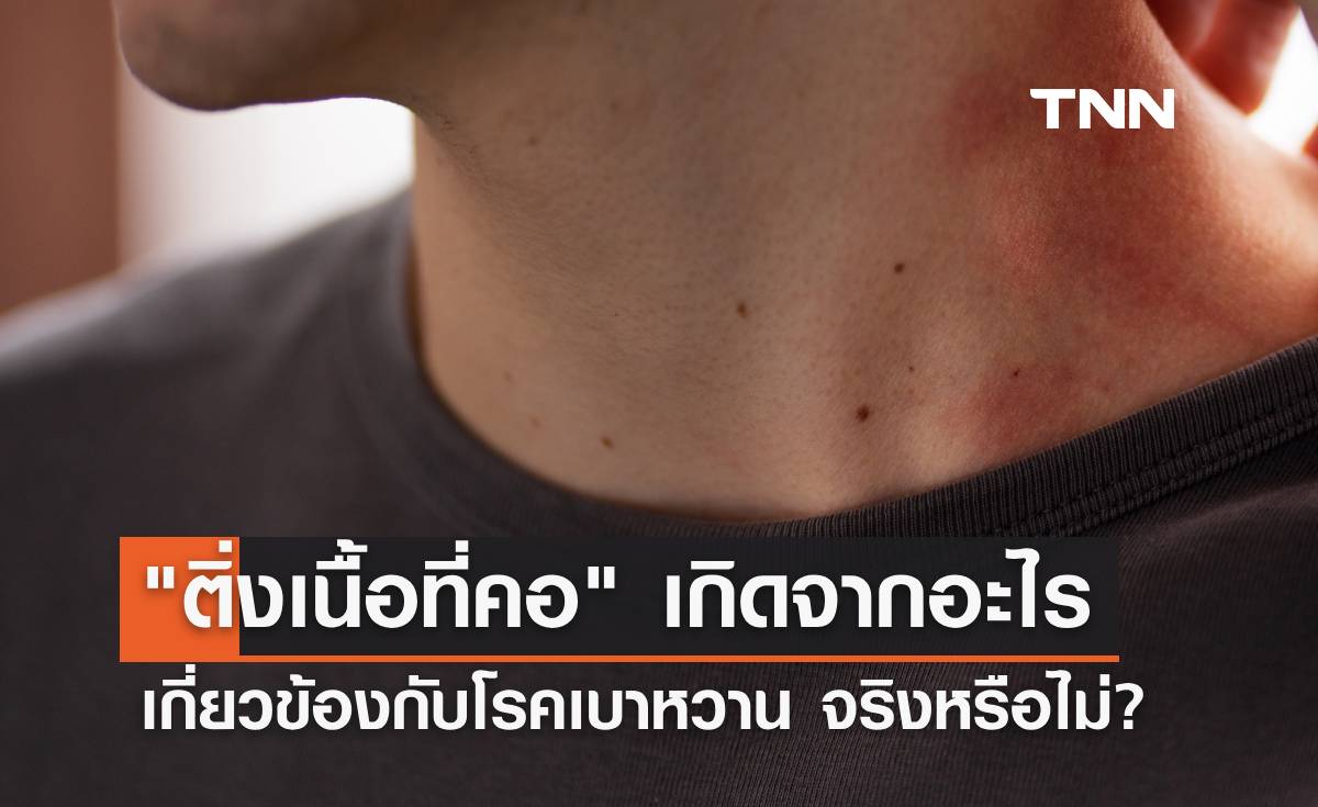 "ติ่งเนื้อที่คอ" เกิดจากอะไร เกี่ยวข้องกับโรคเบาหวาน จริงหรือไม่ หาคำตอบได้ที่นี่!