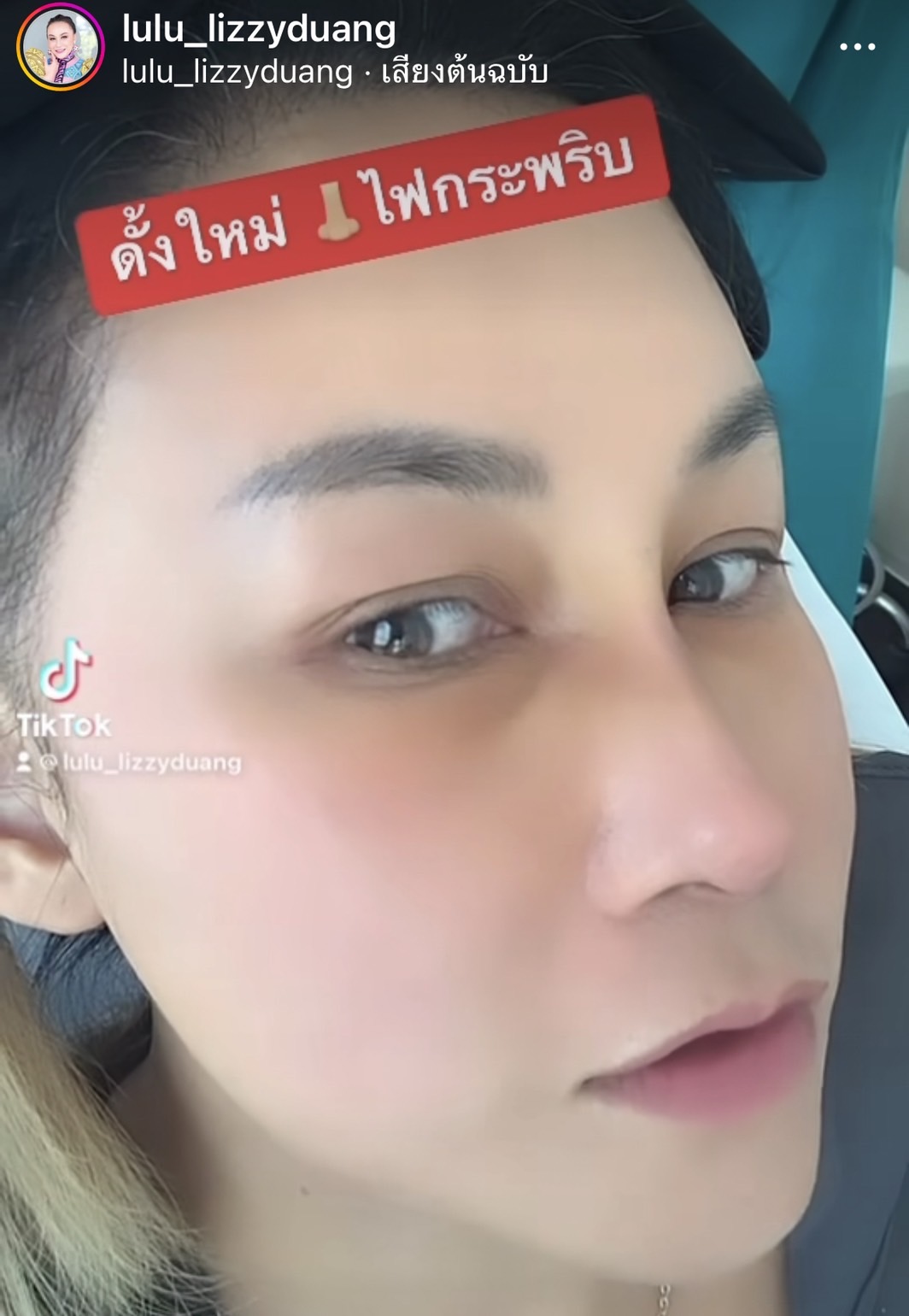 ลูลู่ อวดจมูกใหม่ สวยสมใจ!! หลังขึ้นเขียงทำศัลยกรรมครั้งแรก!! ลูลู่ อวดจมูกใหม่ สวยสมใจ!! หลังขึ้นเขียงทำศัลยกรรมครั้งแรก!!