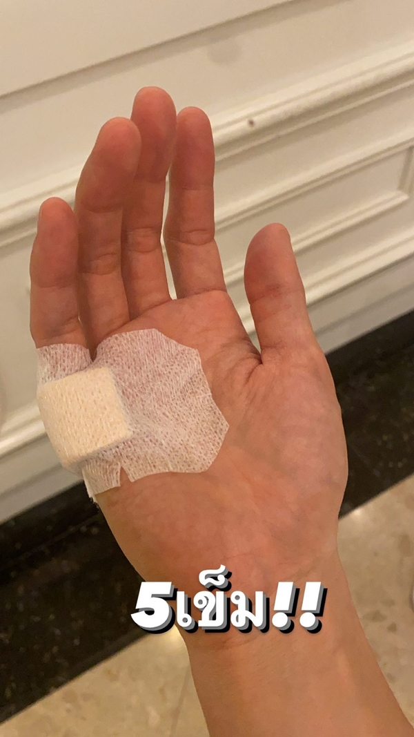 กอล์ฟ พิชญะ หิวมือสั่น จานหลุดมือ เย็บ 5 เข็ม!! กอล์ฟ พิชญะ หิวมือสั่น จานหลุดมือ เย็บ 5 เข็ม!!