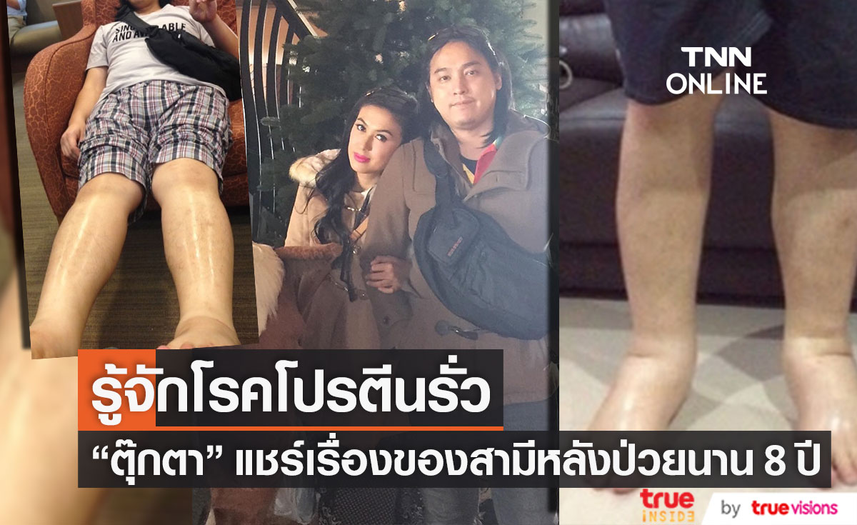 รู้จักโรคโปรตีนรั่ว "ตุ๊กตา" แชร์ประสบการณ์ของสามี ตัวบวมน้ำหนักขึ้นเกือบ 100 กิโล!!