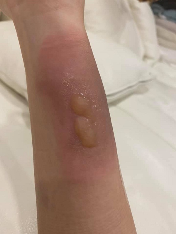  “กระติ๊บ ชวัลกร” หวิดเสียโฉม หลังถูกน้ำมันลวกครั้งที่ 2 (มีคลิป)